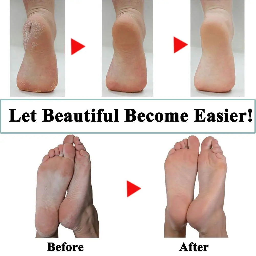 Pedi Hard Skin Remover Rollers for Effective Foot Care - Smarsty