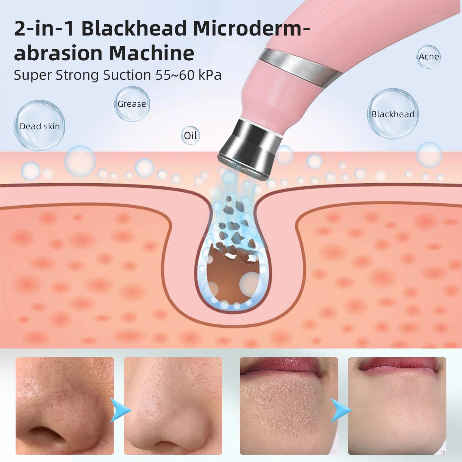 Professional Diamond Microdermabrasion Machine for Home Use - Smarsty