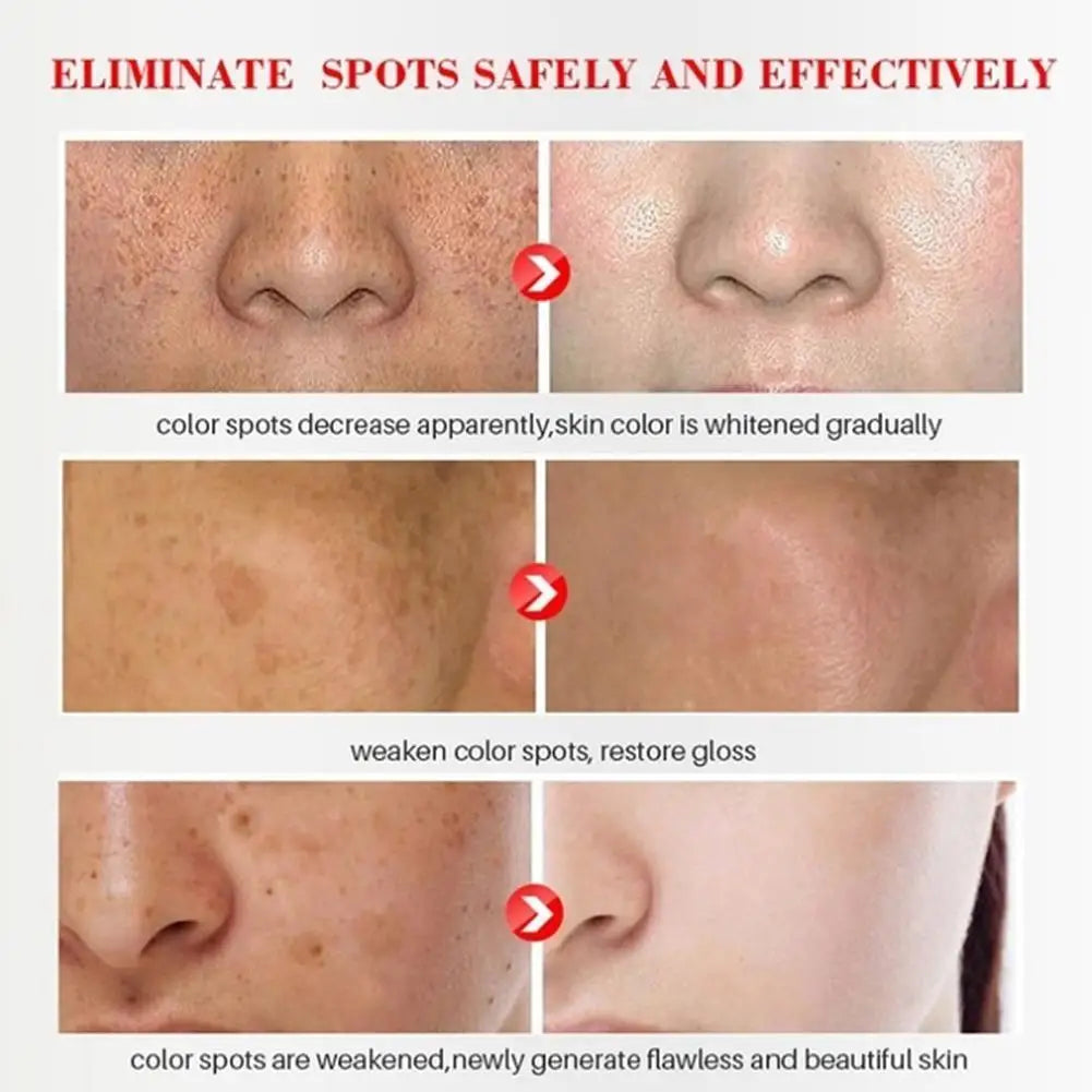 Whitening Freckle Cream for Dark Spot Removal - Smarsty