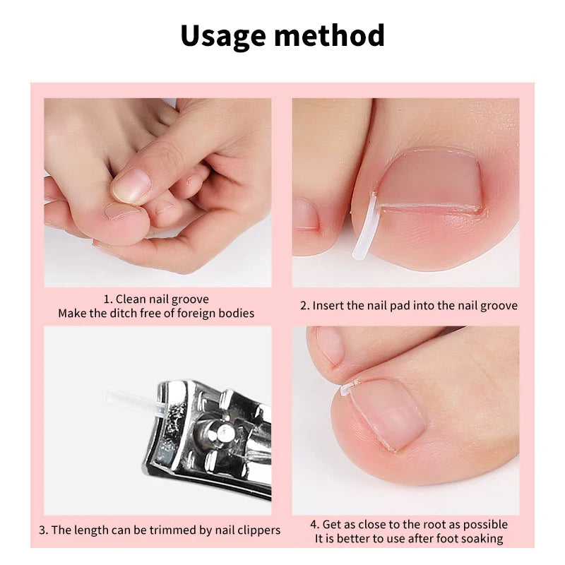 Ingrown Toenail Correction Strips for Pain Relief - Smarsty