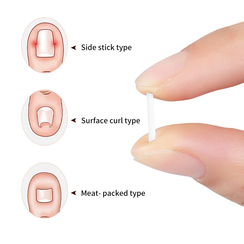 Ingrown Toenail Correction Strips for Pain Relief - Smarsty