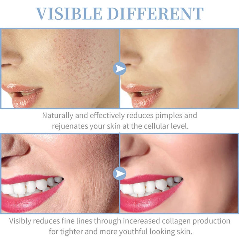 Portable High Frequency Skin Therapy Wand for Acne and Wrinkle Reduction - Smarsty