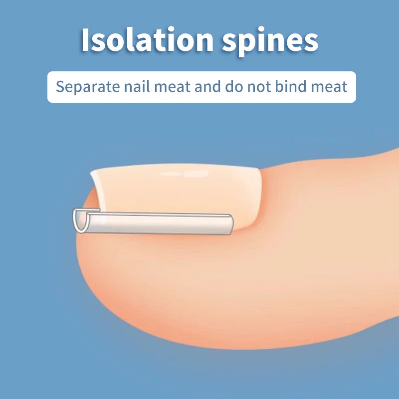 Ingrown Toenail Correction Strips for Pain Relief - Smarsty