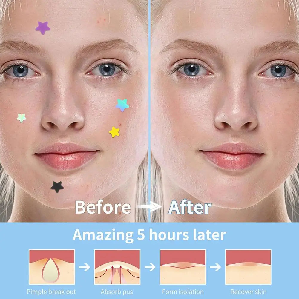 Colorful Star Acne Patches for Spot Treatment - Smarsty