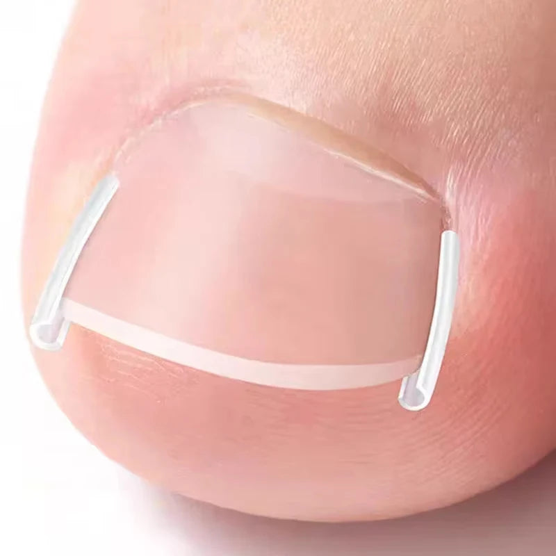 50Pcs Ingrown Toenail Correction Pads for Pain Relief - Smarsty