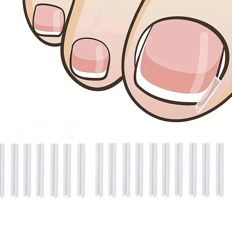 Ingrown Toenail Correction Tool with Elastic Patch - Smarsty