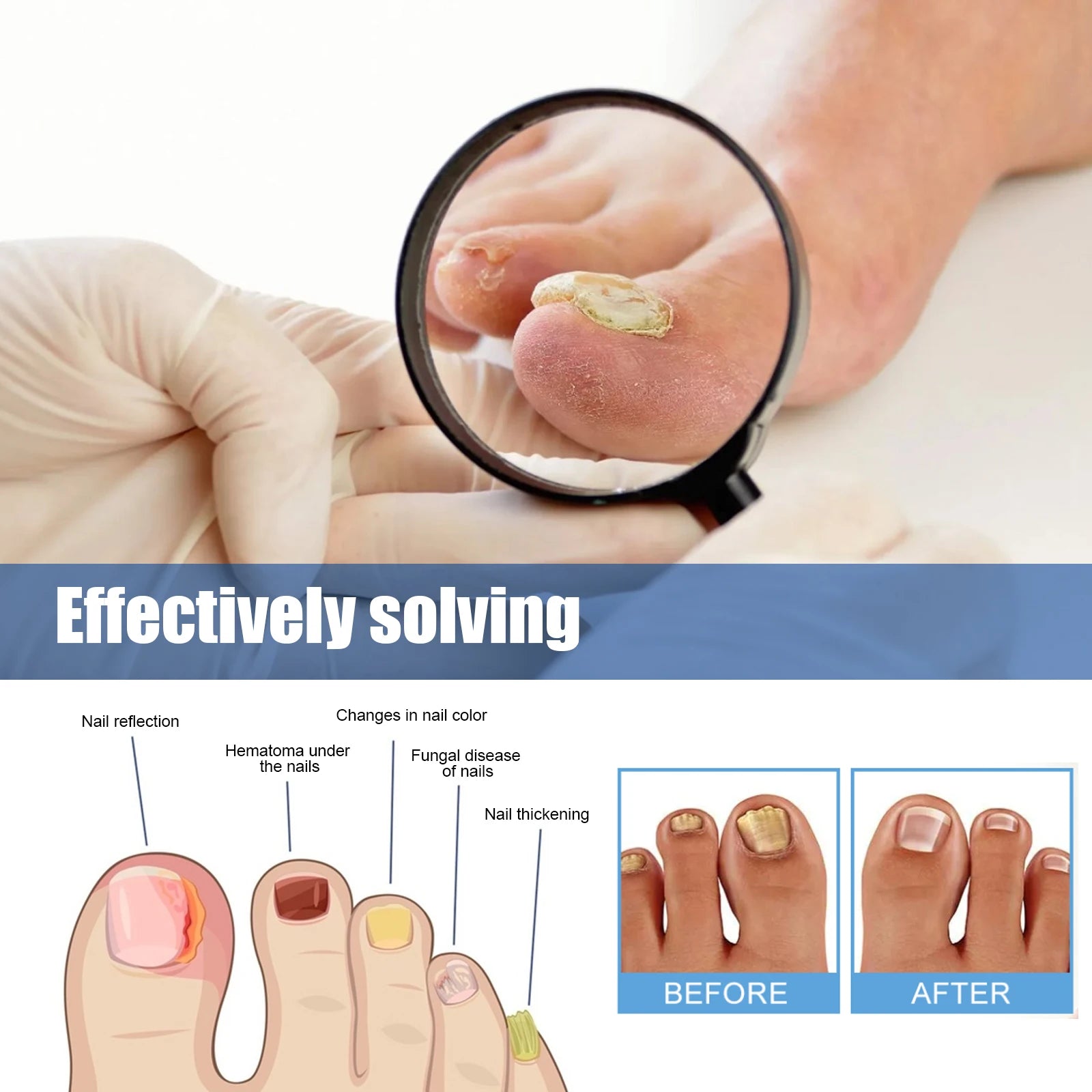 Nail Repair Patches for Toenail Fungus Relief - Smarsty