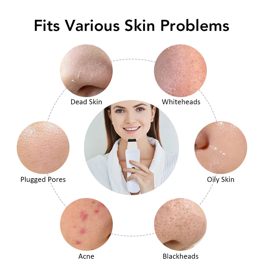 Ultrasonic Skin Scrubber Deep Cleansing Blackhead Remover - Smarsty
