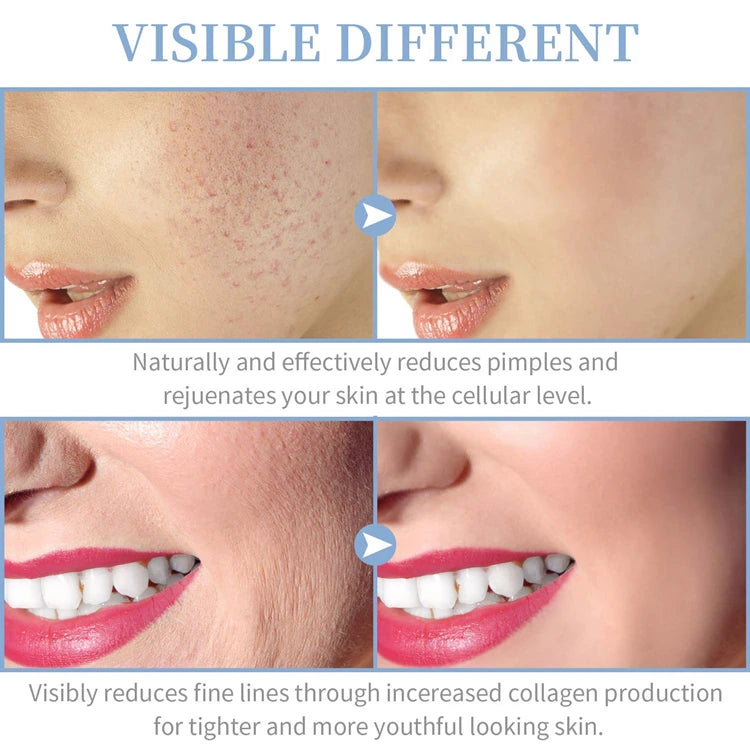 Portable High Frequency Skin Therapy Wand for Acne and Wrinkle Reduction - Smarsty