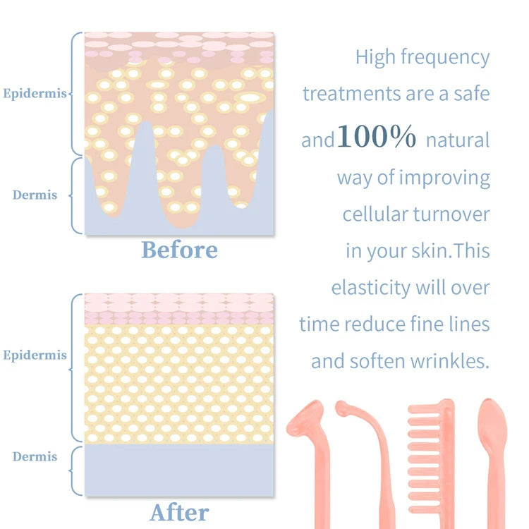 Portable High Frequency Skin Therapy Wand for Acne and Wrinkle Reduction - Smarsty