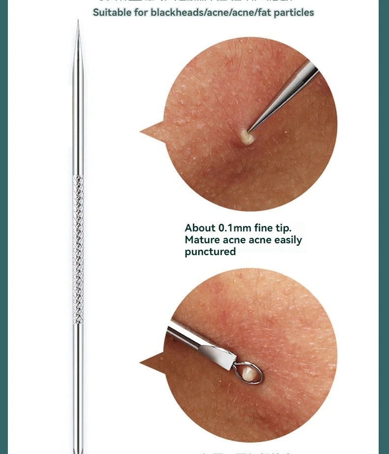 4 Piece Acne Blackhead Removal Needle Set - Smarsty