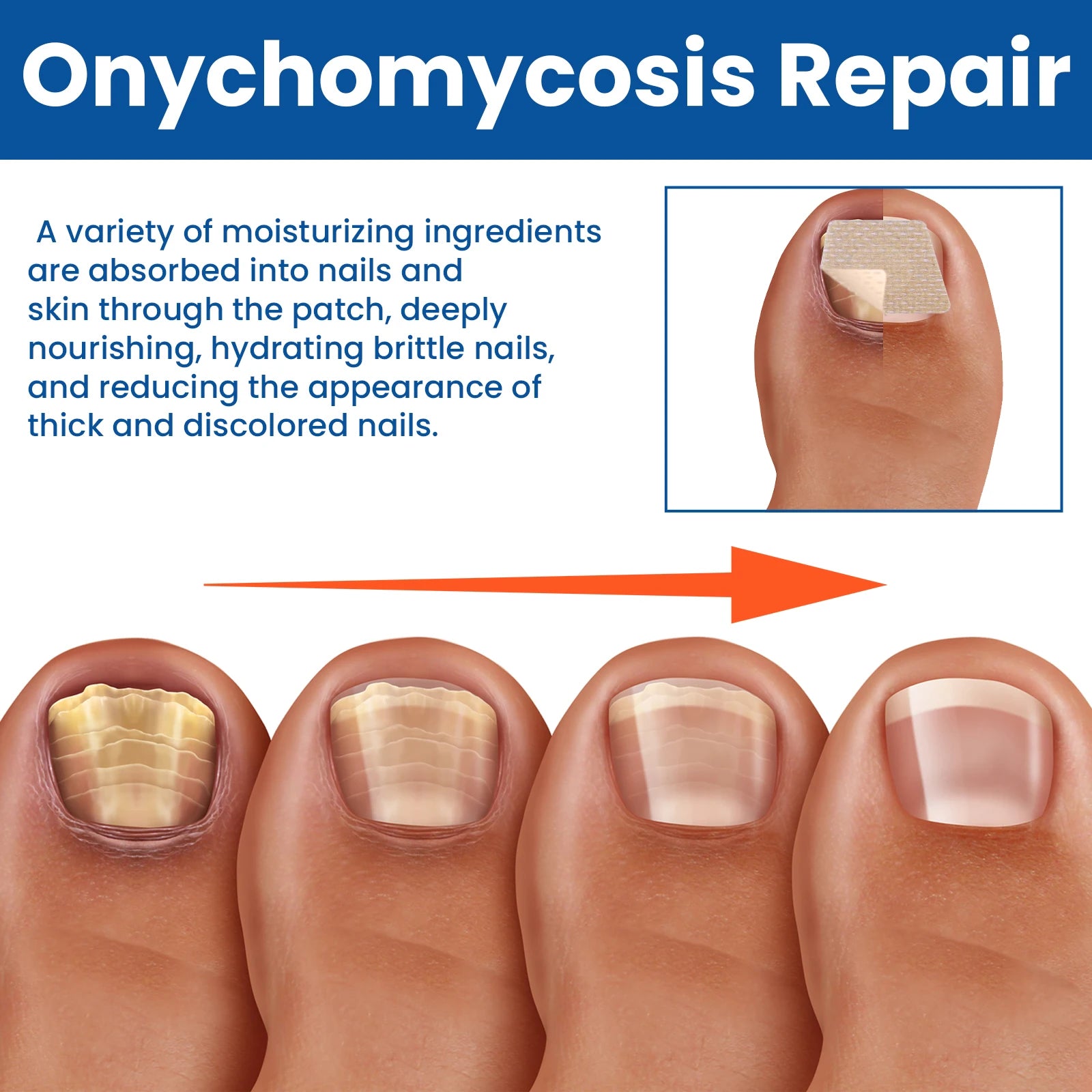 Nail Repair Patches for Toenail Fungus Relief - Smarsty