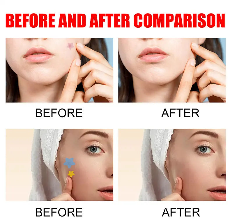 Effective Acne Repair Patch for Fading Blemishes - Smarsty