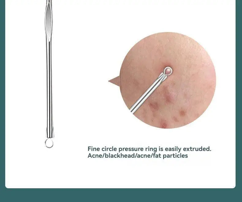 4 Piece Acne Blackhead Removal Needle Set - Smarsty