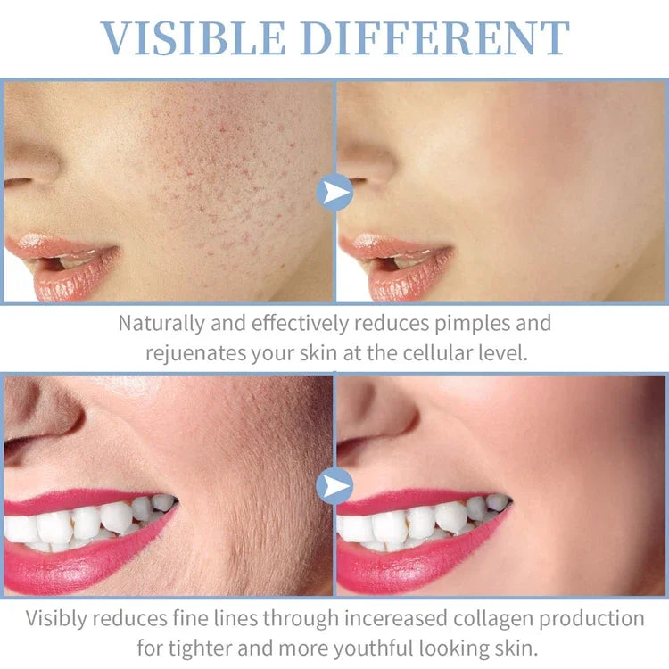 Handheld Electric Facial Therapy Wand for Acne Treatment - Smarsty