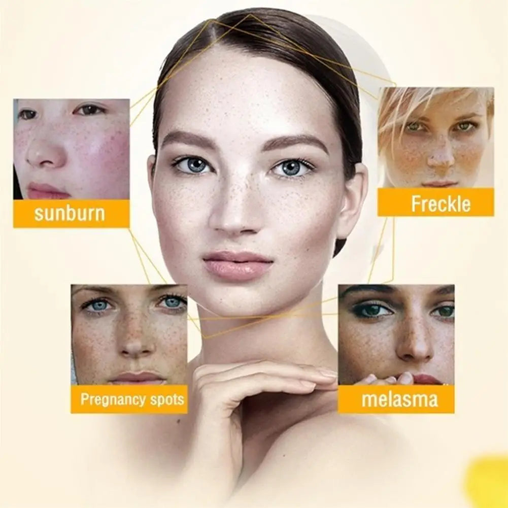Whitening Freckle Cream for Dark Spot Removal - Smarsty