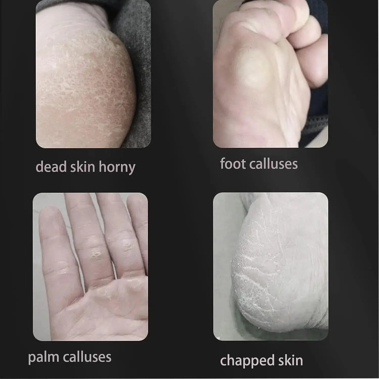 8 Piece Foot Exfoliating Rasp Set for Smooth Heels - Smarsty
