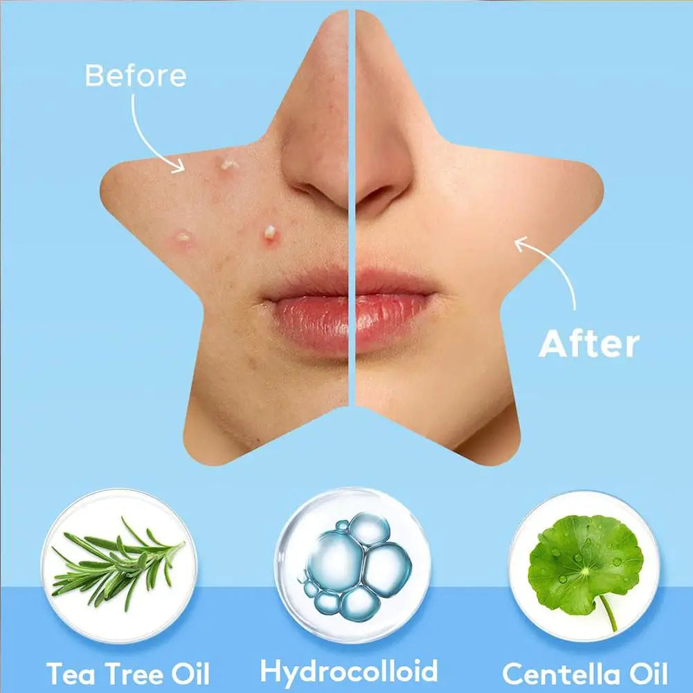 Colorful Star Acne Patches for Spot Treatment - Smarsty