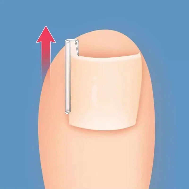 Ingrown Toenail Correction Strips for Pain Relief - Smarsty