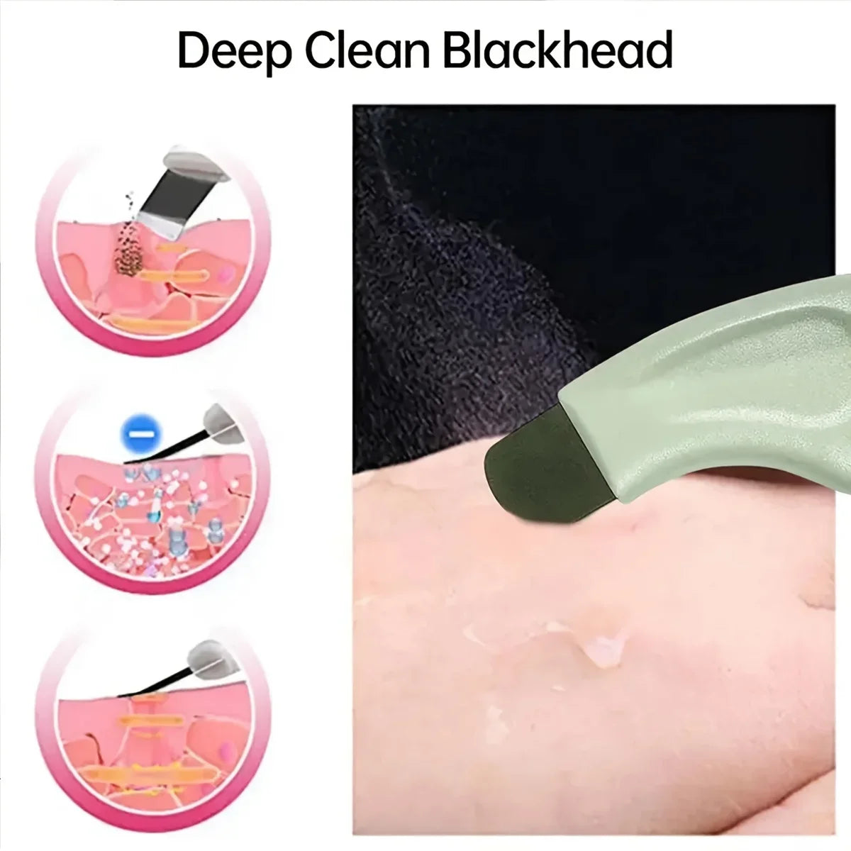 Blackhead and Whitehead Removal Tool for Clear Skin - Smarsty
