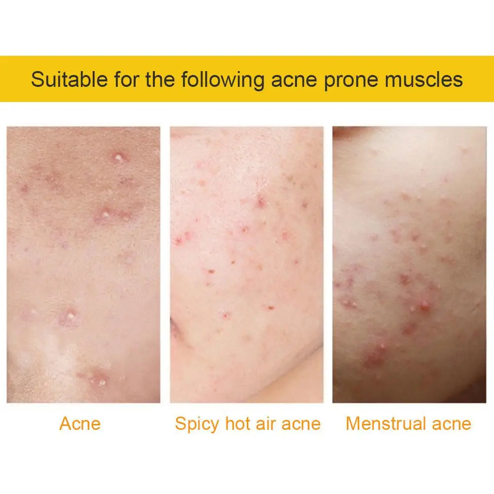 Colorful Star Heart Shaped Acne Pimple Patches - Smarsty