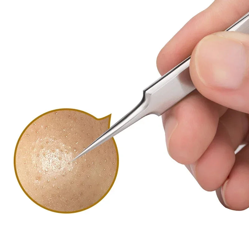 German Ultra Fine Blackhead Remover Tool for Clear Skin - Smarsty
