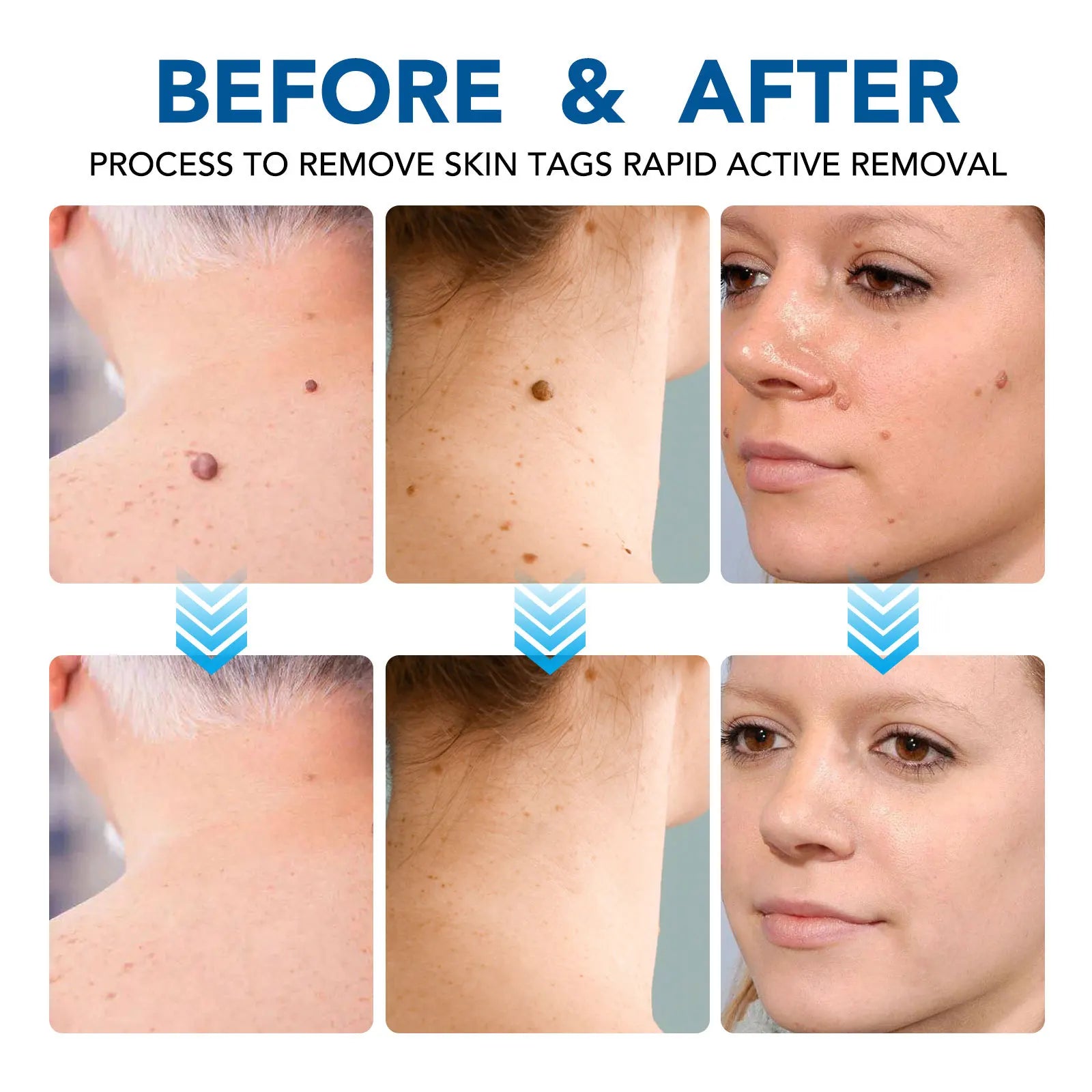 3 In 1 Painless Skin Tag Removal Kit - Smarsty