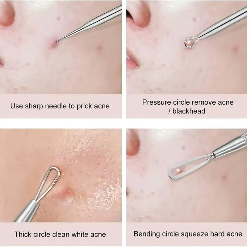 4 Piece Acne Blackhead Removal Needle Set - Smarsty