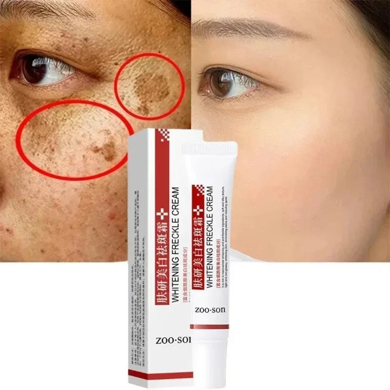 Whitening Freckle Cream for Dark Spot Removal - Smarsty