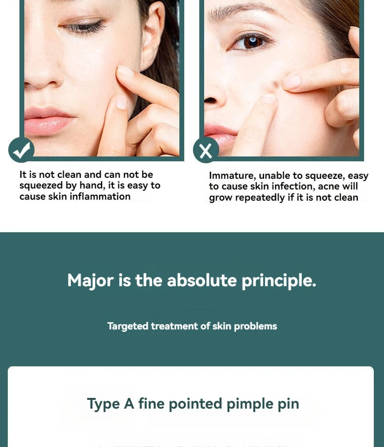 4 Piece Acne Blackhead Removal Needle Set - Smarsty