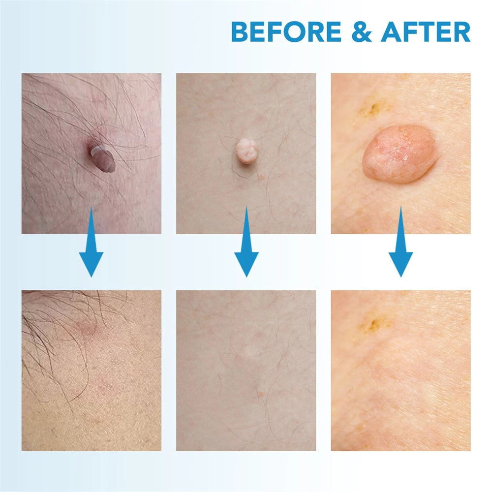2 in 1 Skin Tag Remover Kit for Effective Face Care - Smarsty