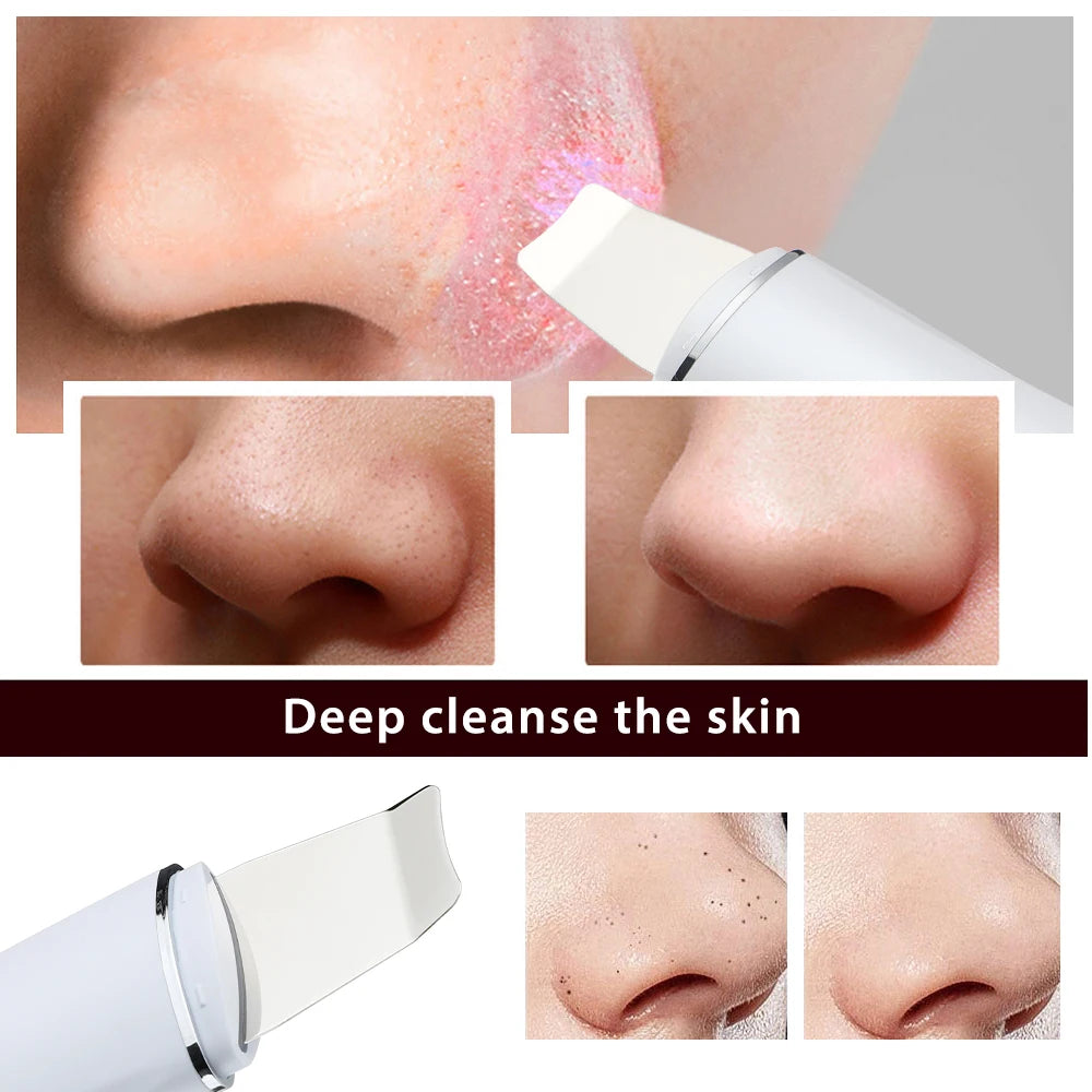 Ultrasonic Skin Scrubber for Deep Pore Cleaning - Smarsty