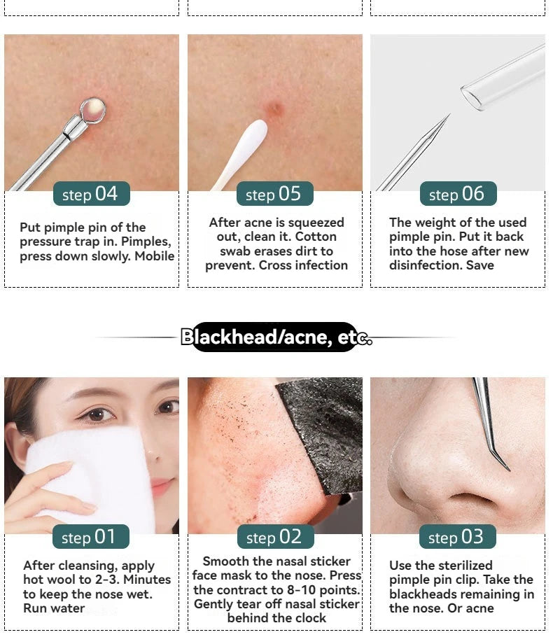 4 Piece Acne Blackhead Removal Needle Set - Smarsty