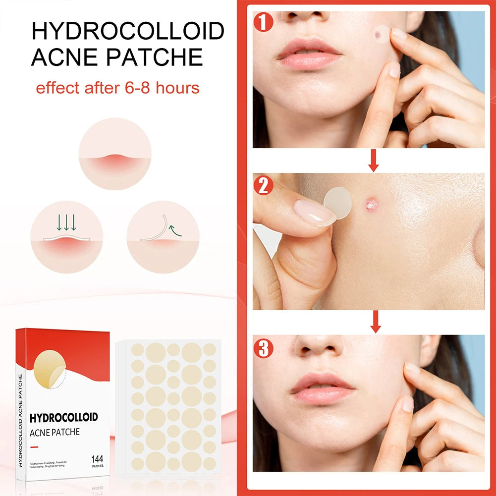 144 Piece Acne Pimple Patch Set for Clear Skin - Smarsty