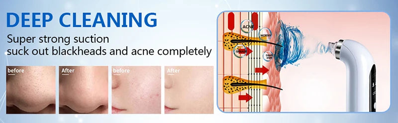 2025 Rechargeable Blackhead Remover Pore Vacuum Cleaner - Smarsty