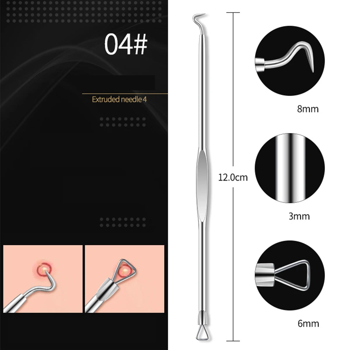 4PCS Acne Remover Tool Set for Clear Skin - Smarsty