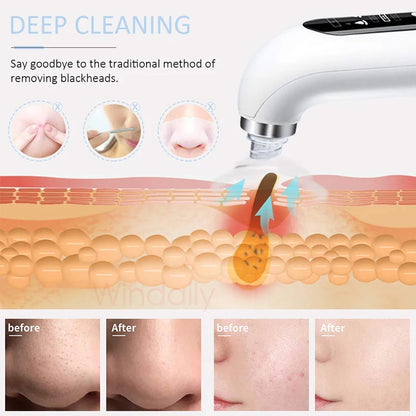 2025 Rechargeable Blackhead Remover Pore Vacuum Cleaner - Smarsty