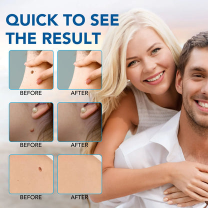 3 In 1 Painless Skin Tag Removal Kit - Smarsty