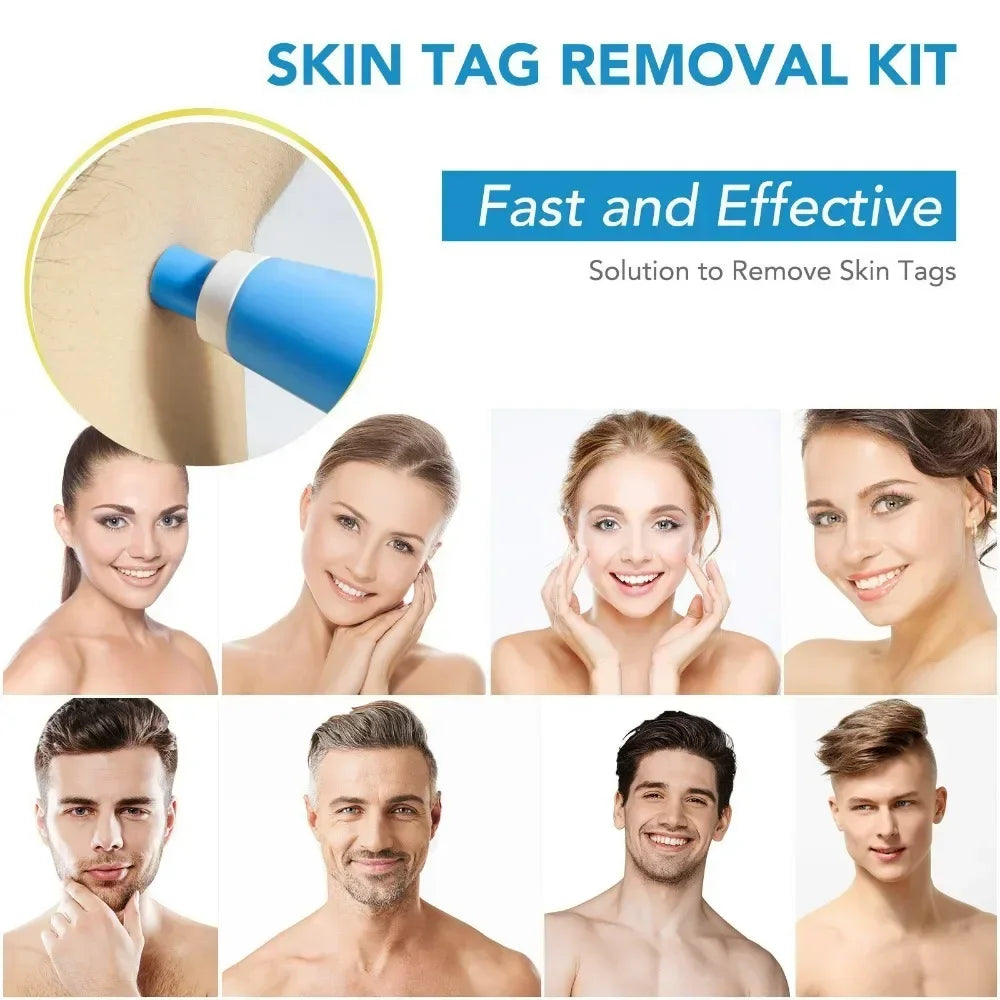 Painless Skin Tag and Wart Removal Kit - Smarsty