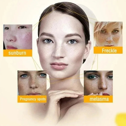 Whitening Freckle Cream for Dark Spot Removal - Smarsty