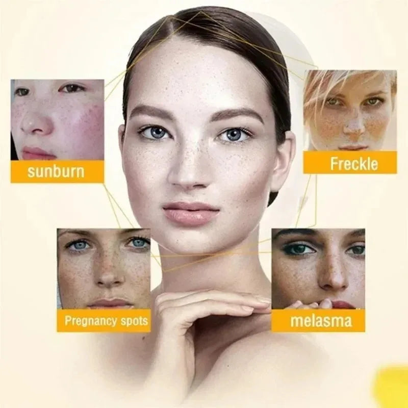 Whitening Freckle Cream for Dark Spot Removal - Smarsty