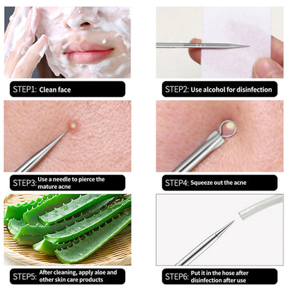 4PCS Acne Remover Tool Set for Clear Skin - Smarsty