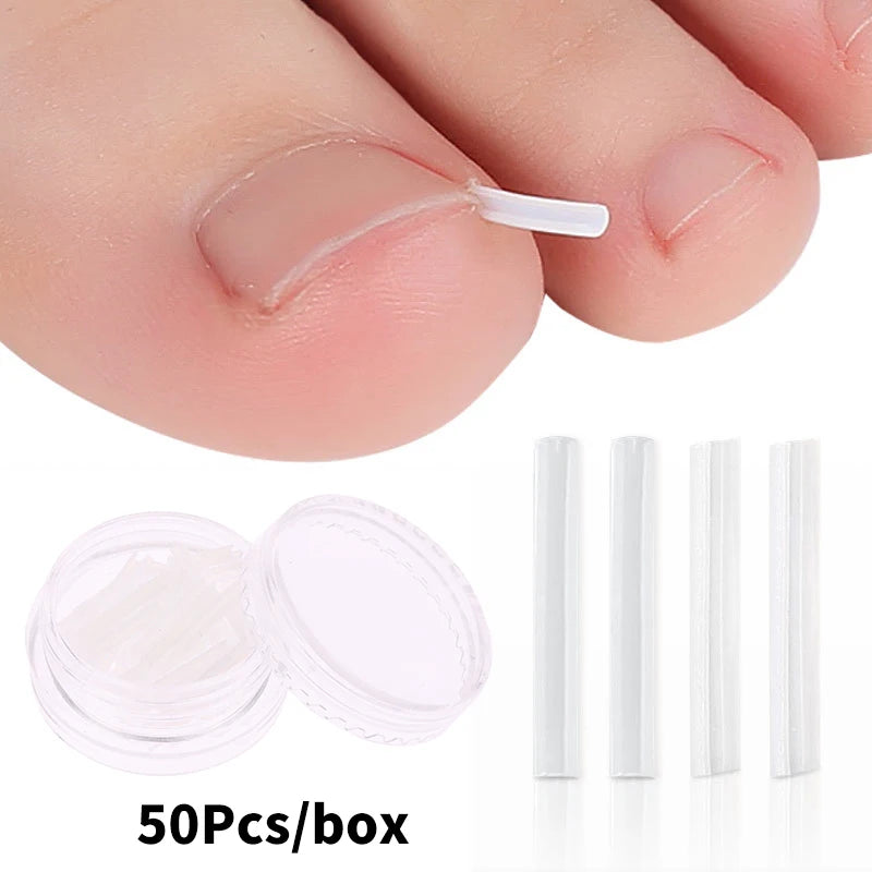 Ingrown Toenail Correction Strips for Pain Relief - Smarsty
