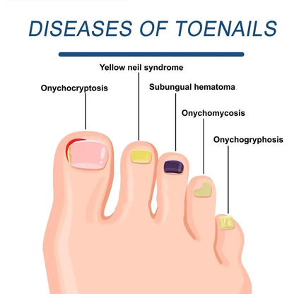 Nail Care Device for Fungal Treatment and Repair - Smarsty