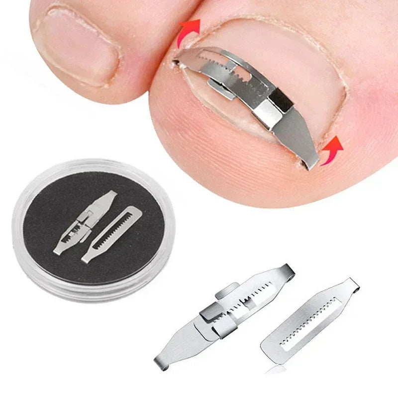 Ingrown Toenail Correction Tool for Effective Foot Care - Smarsty