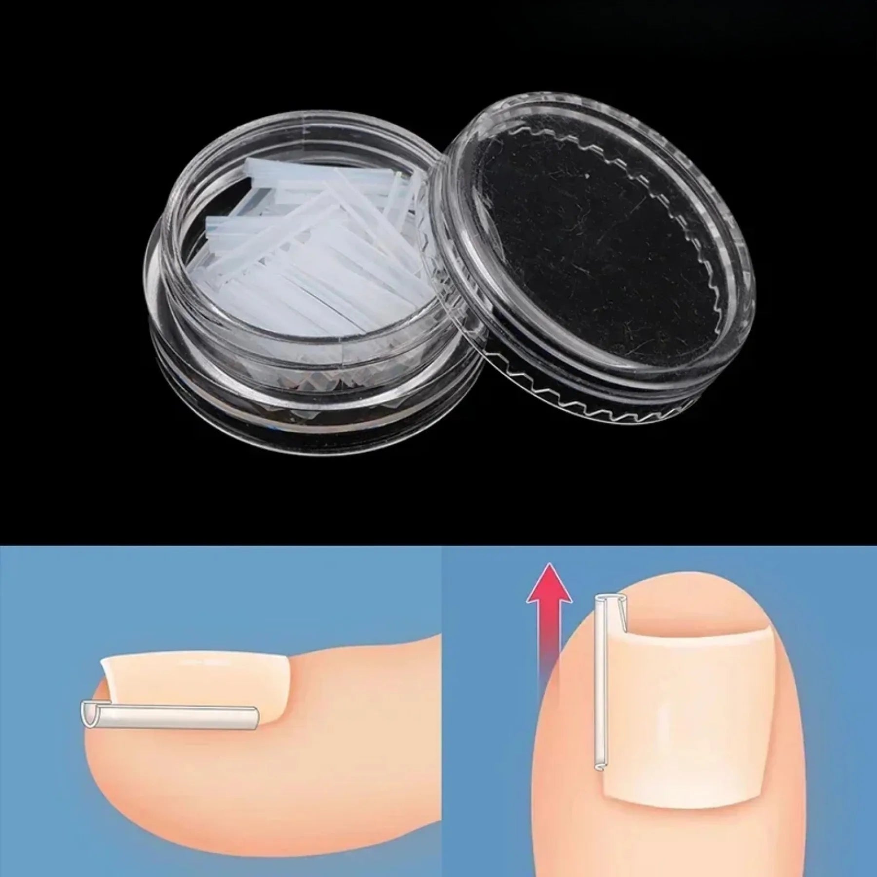 Ingrown Toenail Correction Tool Set for Effective Treatment - Smarsty