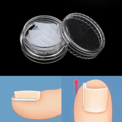Ingrown Toenail Correction Tool Set for Effective Treatment - Smarsty