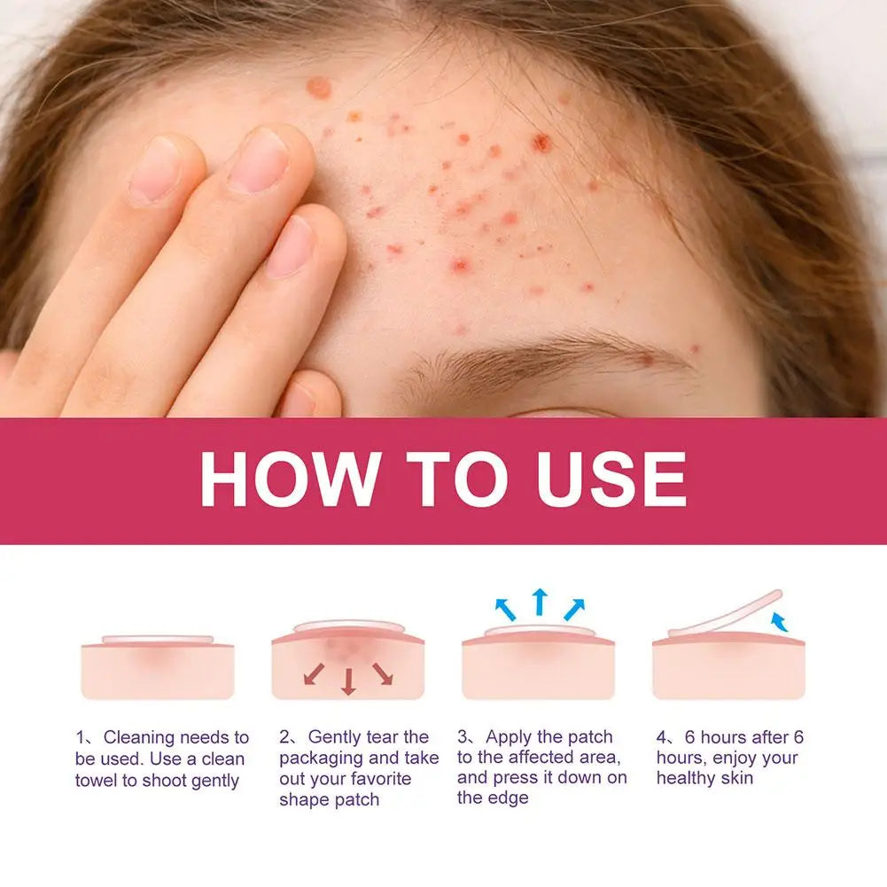 144 Piece Colorful Invisible Acne Patches for Clear Skin - Smarsty