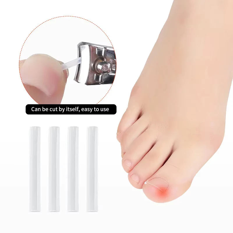 Ingrown Toenail Correction Tool with Elastic Patch - Smarsty