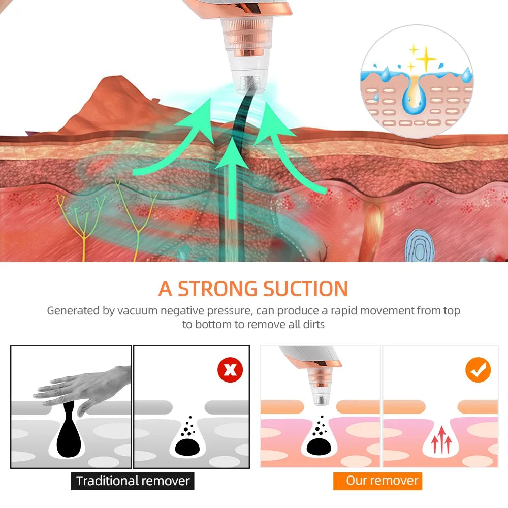 Vacuum Blackhead Remover With USB Charging Convenience - Smarsty